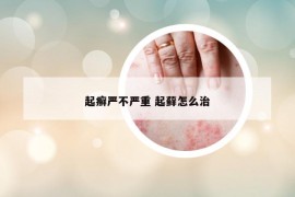 起癣严不严重 起藓怎么治