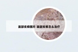 面部皮癣图片 面部皮癣怎么治疗