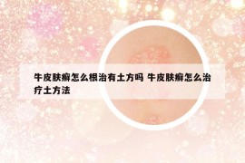 牛皮肤癣怎么根治有土方吗 牛皮肤癣怎么治疗土方法