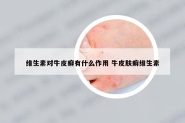 维生素对牛皮癣有什么作用 牛皮肤癣维生素