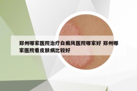 郑州哪家医院治疗白癜风医院哪家好 郑州哪家医院看皮肤病比较好