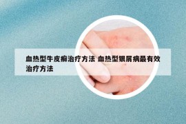 血热型牛皮癣治疗方法 血热型银屑病最有效治疗方法