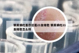 银屑病吃善存还是21金维他 银屑病吃21金维他怎么样