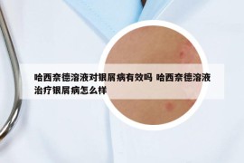 哈西奈德溶液对银屑病有效吗 哈西奈德溶液治疗银屑病怎么样