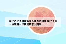 脖子边上长的和癣差不多怎么回事 脖子上有一块跟癣一样的皮癣怎么回事