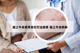 腿上牛皮癣发青红烂这回事 腿上牛皮肤癣