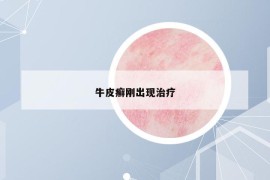 牛皮癣刚出现治疗