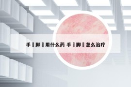 手廯脚廯用什么药 手廯脚廯怎么治疗