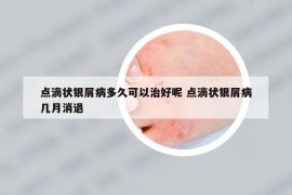 点滴状银屑病多久可以治好呢 点滴状银屑病几月消退