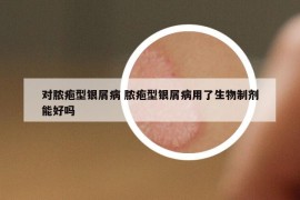 对脓疱型银屑病 脓疱型银屑病用了生物制剂能好吗