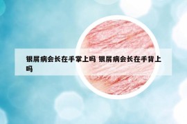 银屑病会长在手掌上吗 银屑病会长在手背上吗