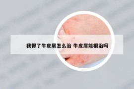 我得了牛皮屑怎么治 牛皮屑能根治吗