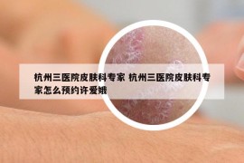 杭州三医院皮肤科专家 杭州三医院皮肤科专家怎么预约许爱娥