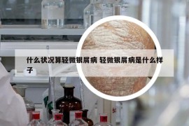 什么状况算轻微银屑病 轻微银屑病是什么样子