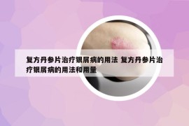 复方丹参片治疗银屑病的用法 复方丹参片治疗银屑病的用法和用量