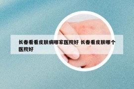 长春看看皮肤病哪家医院好 长春看皮肤哪个医院好