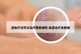 透血疗法可以治疗银屑病吗 血透治疗皮肤病