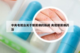 中央电视台关于银屑病的新闻 央视银屑病药浴