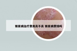 银屑病治疗费用高不高 银屑病费钱吗