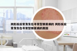 同形反应常发生在寻常型银屑病的 同形反应常发生在寻常型银屑病的原因