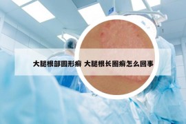 大腿根部圆形癣 大腿根长圈癣怎么回事