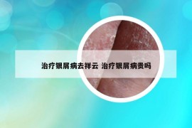 治疗银屑病去祥云 治疗银屑病贵吗