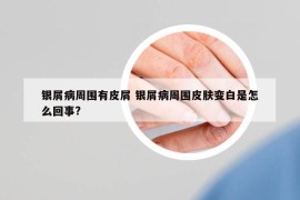 银屑病周围有皮屑 银屑病周围皮肤变白是怎么回事?