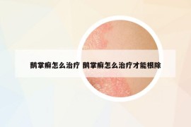 鹅掌癣怎么治疗 鹅掌癣怎么治疗才能根除