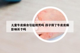 儿童牛皮癣会引起斑秃吗 孩子得了牛皮皮癣影响长个吗