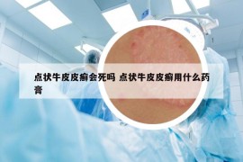 点状牛皮皮癣会死吗 点状牛皮皮癣用什么药膏