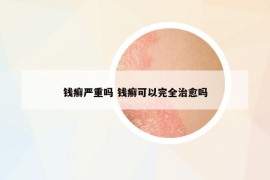 钱癣严重吗 钱癣可以完全治愈吗