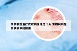 生物制剂治疗皮肤病原理是什么 生物制剂在皮肤病中的应用