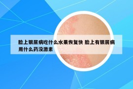 脸上银屑病吃什么水果恢复快 脸上有银屑病用什么药没激素