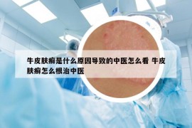 牛皮肤癣是什么原因导致的中医怎么看 牛皮肤癣怎么根治中医