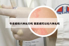 牛皮癣和六神丸行吗 银屑病可以吃六神丸吗