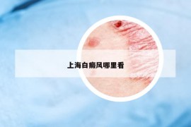 上海白癜风哪里看