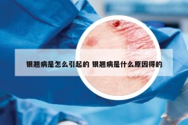 银翘病是怎么引起的 银翘病是什么原因得的