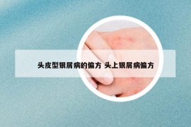 头皮型银屑病的偏方 头上银屑病偏方