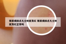 银屑病抹点凡士林就发红 银屑病抹点凡士林就发红正常吗