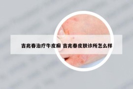 吉兆春治疗牛皮癣 吉兆春皮肤诊所怎么样