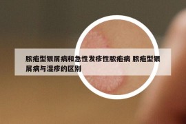 脓疱型银屑病和急性发疹性脓疱病 脓疱型银屑病与湿疹的区别