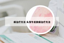 癣治疗方法 头发牛皮肤癣治疗方法