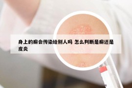 身上的癣会传染给别人吗 怎么判断是癣还是皮炎