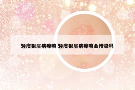 轻度银屑病痒嘛 轻度银屑病痒嘛会传染吗