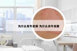 为什么有牛皮癣 为什么会牛皮廨