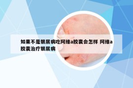 如果不是银屑病吃阿维a胶囊会怎样 阿维a胶囊治疗银屑病