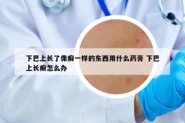 下巴上长了像癣一样的东西用什么药膏 下巴上长癣怎么办