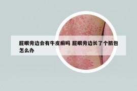 屁眼旁边会有牛皮癣吗 屁眼旁边长了个脓包怎么办