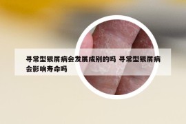 寻常型银屑病会发展成别的吗 寻常型银屑病会影响寿命吗