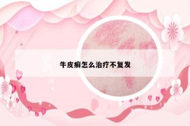 牛皮癣怎么治疗不复发